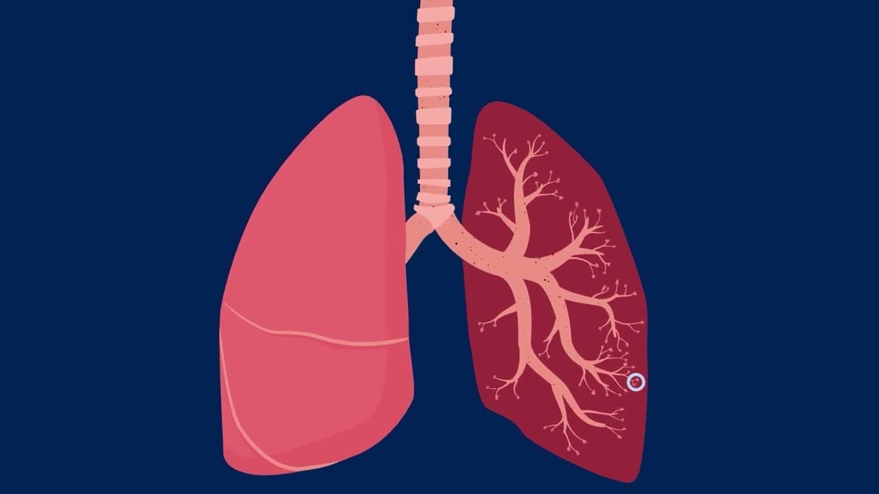 How Particle Pollution Impacts Your Lungs